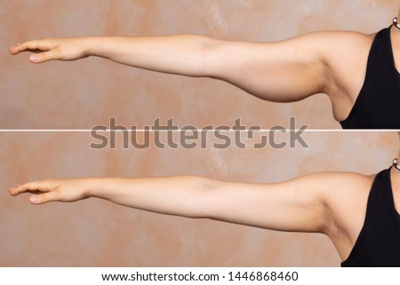 A before and after view of a young Caucasian lady who had a brachioplasty. Popular arm lift surgery which removes the sagging fat layer from the upper arm. Royalty-Free Stock Photo #1446868460