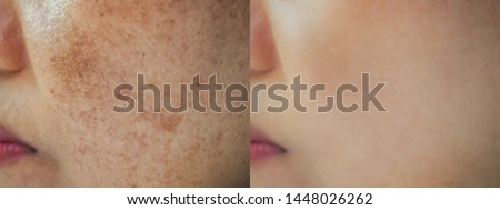  Image before and after dark spot melasma pigmentation skin on face asian woman. Problem skincare and health concept. 