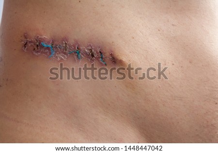 The picture shows a medical scar after surgery after removal of a malignant tumor 