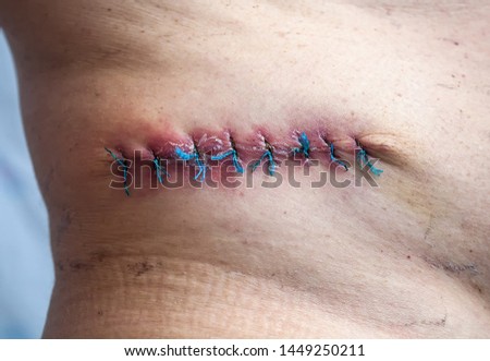 The picture shows a medical scar after removing a malignant mole. Oncology, skin cancer.
