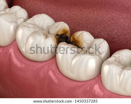 Molar teeth damaged by caries. Medically accurate tooth 3D illustration.