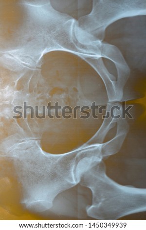 x-ray of the female hip joint, female problems, uterine and ovarian problems, arthritis and arthrosis of the joints.