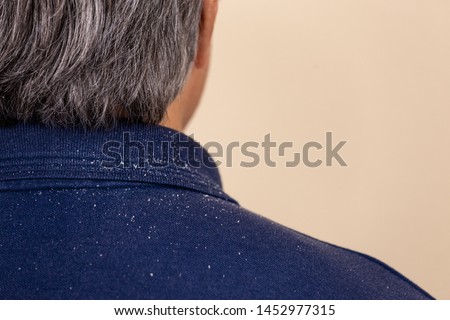 Close-up view of a man who has a lot of dandruff from his hair on his shirt and shoulders. Royalty-Free Stock Photo #1452977315