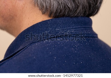 Close-up view of a man who has a lot of dandruff from his hair on his shirt and shoulders. Royalty-Free Stock Photo #1452977321