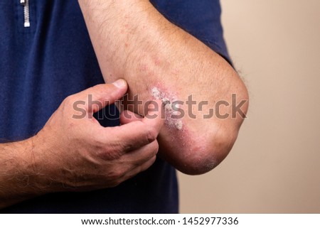 Close up dermatitis on skin, ill allergic rash dermatitis eczema of patient , atopic dermatitis symptom skin detail texture , Fungus The concept dermatology, treatment fungal and fungal. Royalty-Free Stock Photo #1452977336