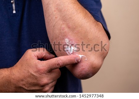 Concept photo of treatment of skin diseases using ointments as dosage form of drug. Patient causes medical therapeutic ointment thick consistency or cream moisturizer on skin in elbow area close-up. Royalty-Free Stock Photo #1452977348