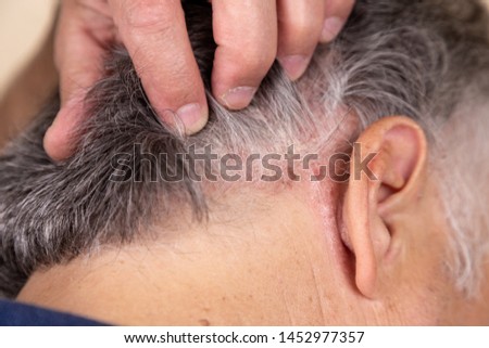 Psoriasis Vulgaris, psoriatic skin disease in head hair, skin patches are typicaly red, itchy, and scaly, macro with narrow focus. Royalty-Free Stock Photo #1452977357