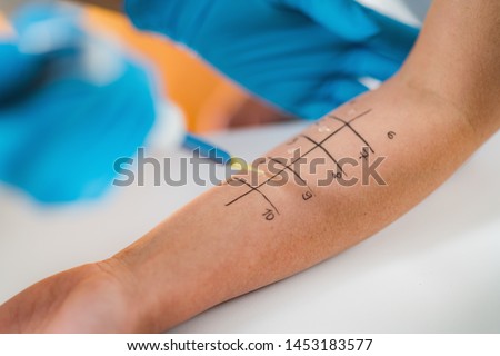 Allergy Test- Skin Prick Allergy Testing for Possible Allergens Royalty-Free Stock Photo #1453183577