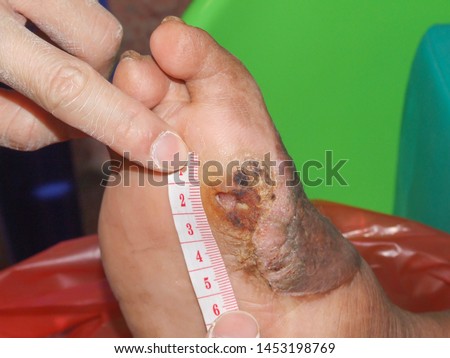 Doctor use measurement tape to measuring size of wound at foot of diabetic patient. Diabetic wound are cause of amputation toe or legs. Royalty-Free Stock Photo #1453198769