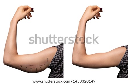 Arrows show the before and after results of a successful brachio Royalty-Free Stock Photo #1453320149