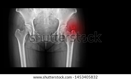 Film X-ray hip radiograph showing calcium deposit on abductor tendon of right hip (calcific tendinitis or tendinosis calcarea). This calcified tendon cause hip pain and stiffness. medical concept. Royalty-Free Stock Photo #1453405832