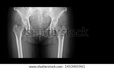 Film X-ray hip radiograph showing calcium deposit on abductor tendon of right hip (calcific tendinitis or tendinosis calcarea). This calcified tendon cause hip pain and swelling. Royalty-Free Stock Photo #1453405961