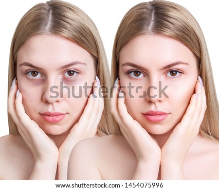 Young woman with bruises under eyes before and after treatment. Over white background.