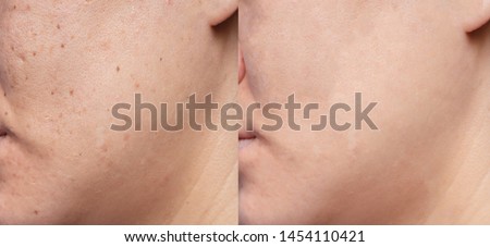 Picture of before and after treatment in beauty clinic of Woman's problematic skin , acne scars ,oily skin and pore, dark spots and blackhead and whitehead on the face.