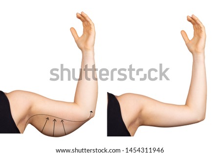 A Caucasian lady holds her arm in the air, isolated against a white background. Arrows show the saggy fat (bingo wing) before surgery. Image on the right shows results after a lift. Royalty-Free Stock Photo #1454311946