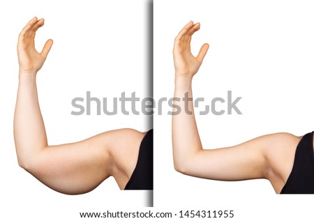 A young Caucasian woman holds her arm in the air, isolated against a clean white background. Showing the before and after results of a successful brachioplasty procedure. Royalty-Free Stock Photo #1454311955