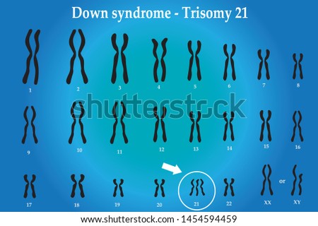 Karyotype of Down syndrome (DS or DNS), also known as trisomy 21, is a genetic disorder caused by the presence of all or part of a third copy of chromosome 21 Royalty-Free Stock Photo #1454594459