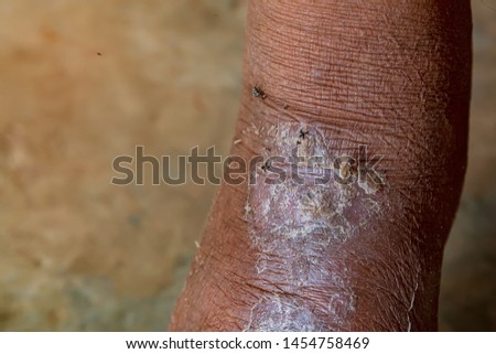 Flies come to the wound of an old man on the leg. Legs of old men who are wound from diabetes are being infected by insects.