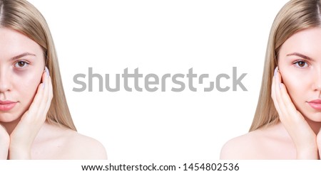 Young woman with bruises under eyes before and after treatment. Copy space. Over white background.