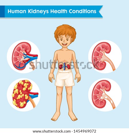 Scientific medical illustration of kidney disease illustration