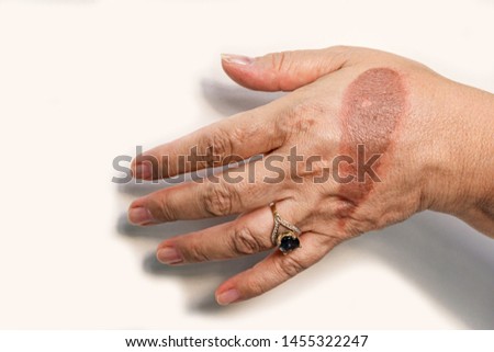 Hand of senior woman with second degree injury thermal burn of skin after boiling water on white background. Home accident, careless behavior with boiling tea. On finger is jewel ring with blue stone Royalty-Free Stock Photo #1455322247