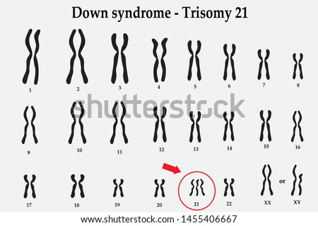 Karyotype of Down syndrome (DS or DNS), also known as trisomy 21, is a genetic disorder caused by the presence of all or part of a third copy of chromosome 21 Royalty-Free Stock Photo #1455406667