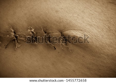 Black and white image. Sepia. Close-up. Department of Oncology Surgery. A picture of a postoperative medical suture after removal of a malignant tumor - moles. Malignant melanoma
