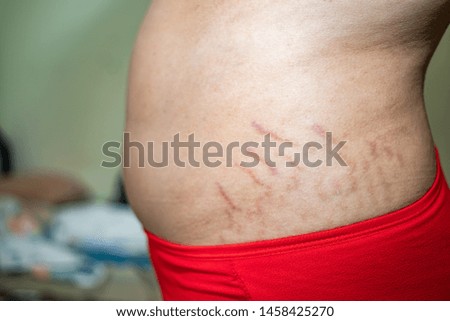 Close up stomach side of stretch marks, fat and cellulite 