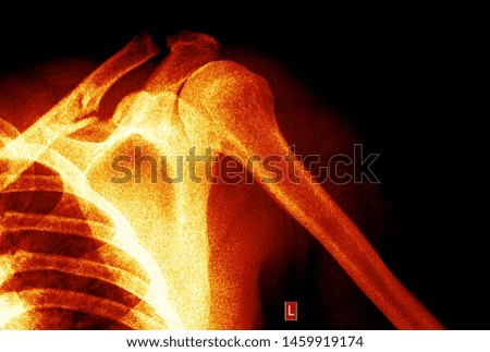 Shoulder x ray anatomy radiology. Radiographic Anatomy - Hand AP Medical Coding, Anatomy And Physiology color on black background