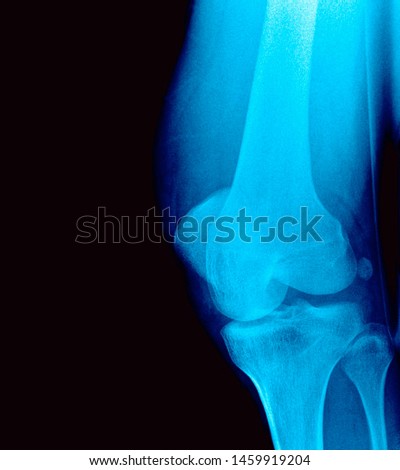 Genu x ray anatomy radiology. Radiographic Anatomy - Hand AP Medical Coding, Anatomy And Physiology color on black background