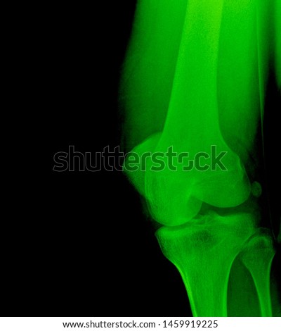 Genu x ray anatomy radiology. Radiographic Anatomy - Hand AP Medical Coding, Anatomy And Physiology color on black background