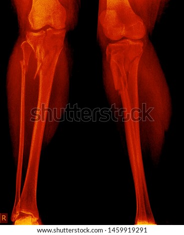 Cruris x ray anatomy radiology. Radiographic Anatomy - Hand AP Medical Coding, Anatomy And Physiology color on black background