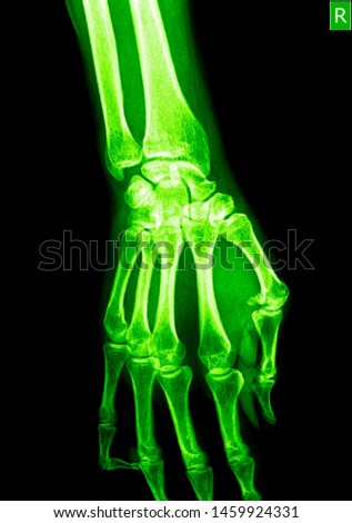Wrist x ray anatomy radiology. Radiographic Anatomy - Hand AP Medical Coding, Anatomy And Physiology color on black background