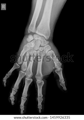 Manus x ray anatomy radiology. Radiographic Anatomy - Hand AP Medical Coding, Anatomy And Physiology color on black background