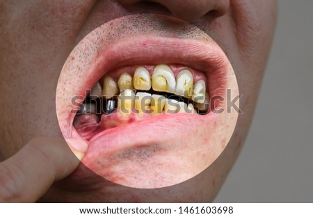 Teeth implantation. Dental post preparation. Medical problem. Caries concept.