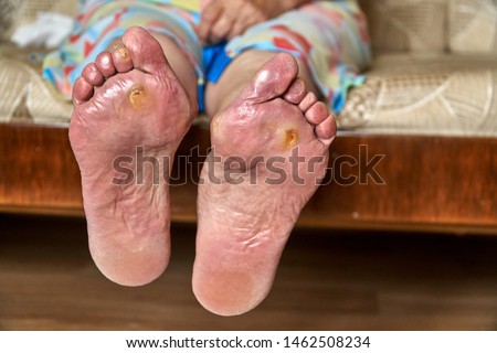 An elderly woman feet with podagra, fungus and diabetic ucler, callus. Healthcare concept Royalty-Free Stock Photo #1462508234