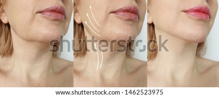 woman double chin before and after treatment Royalty-Free Stock Photo #1462523975