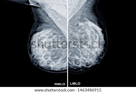 Mammogram radio imaging Both side for breast cancer diagnosis