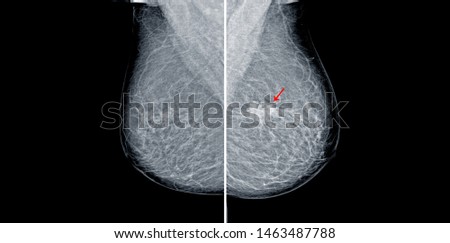 Mammogram radio imaging Both side for breast cancer diagnosis,Mammography image showing left breast calcification to suggest malignancy.