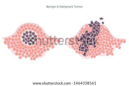 Vector isolated illustration of malignant and benign tumor in healthy tissue. Spreading of cancer cells, tumor development. Medical infographics for poster, educational, science and medical use.  Royalty-Free Stock Photo #1464338561