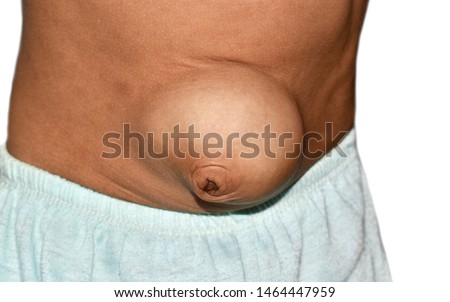 Large congenital umbilical hernia protruding from anterior abdominal wall in Asian baby. It is an abnormal bulge that can be seen at the umbilicus (belly button). Royalty-Free Stock Photo #1464447959