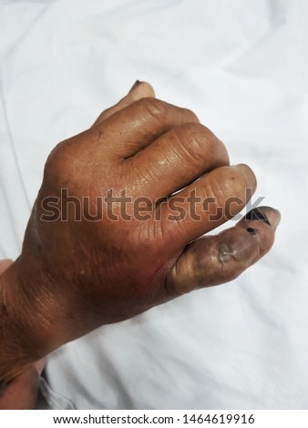cobra bite wound on a fingers Royalty-Free Stock Photo #1464619916