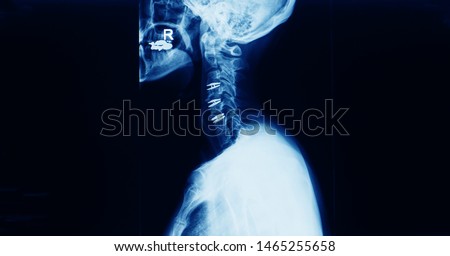 lateral projection x-ray of cervical spine showing multiple level total disc replacement operation in a patient with cervical spondylotic myelopathy. The patient has neck pain and spinal stenosis. Royalty-Free Stock Photo #1465255658
