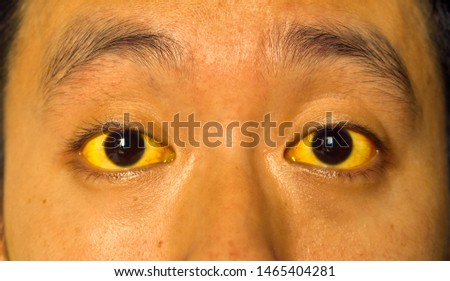 Yellowish discoloration of skin and sclera or deep jaundice in face of Southeast Asian young man. It can occur in hepatitis, cholangitis, cholangiohepatitis, leptospirosis, liver failure and hemolysis Royalty-Free Stock Photo #1465404281