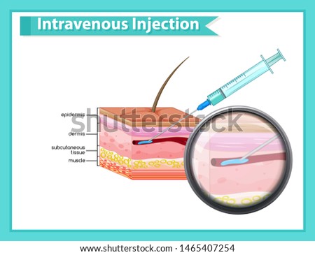 Scientific medical illustration of intravenous injections illustration