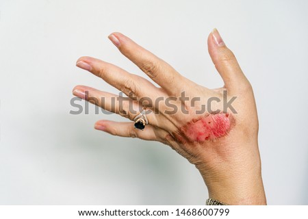 An open wound of woman's hand with thermal burn of second degree injury of skin after boiling water on white background. Home accident, boiling tea sloppy behavior. On finger is ring with blue stone Royalty-Free Stock Photo #1468600799