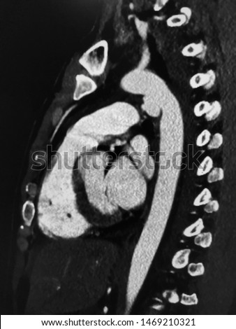 Contrast enhanced computed tomography of aorta (Aortic CTA), one of CT scan imaging technique, showing aneurysm at junction of aortic arch and descending thoracic aorta