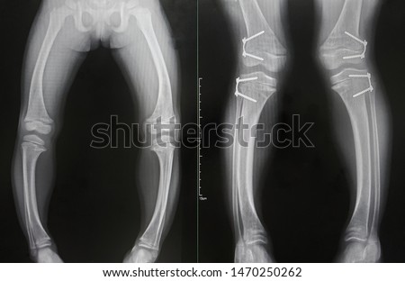 The x-ray of Rickets disease from hypophosphate is shown varus deformity and widening medial physis of bone. The other show improved alignment after the epiphysiodesis of both femurs and tibias. Royalty-Free Stock Photo #1470250262