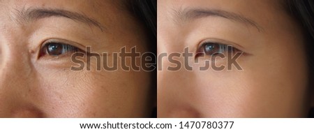 Image before and after treatment rejuvenation surgery on face asian woman concept. Closeup wrinkles dark spots pigmentation on facial female.  Royalty-Free Stock Photo #1470780377