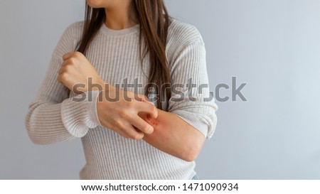 Health allergy skin care problem. Closeup young woman scratching her arm with allergy rash. Woman Scratching an itch . Sensitive Skin, Food allergy symptoms, Irritation Royalty-Free Stock Photo #1471090934